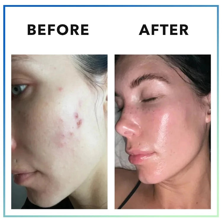 MINDBODYSKIN Hormonal Acne Supplement Before and After Results